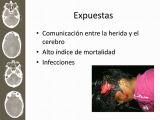 Expuestas
• Comunicación entre la herida y el
cerebro
• Alto índice de mortalidad
• Infecciones
 