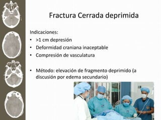 Fractura Cerrada deprimida
Indicaciones:
• >1 cm depresión
• Deformidad craniana inaceptable
• Compresión de vasculatura
• Método: elevación de fragmento deprimido (a
discusión por edema secundario)
 