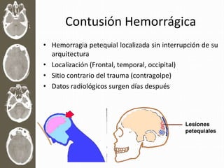 Contusión Hemorrágica
• Hemorragia petequial localizada sin interrupción de su
arquitectura
• Localización (Frontal, temporal, occipital)
• Sitio contrario del trauma (contragolpe)
• Datos radiológicos surgen días después
Lesiones
petequiales
 
