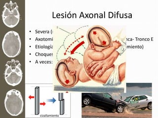 Lesión Axonal Difusa
• Severa (rápido edema)
• Axotomía: Interrumpe Axones de Sust. Blanca- Tronco E
• Etiología: desaceleración Repentina (cizallamiento)
• Choques, Maltrato infantil
• A veces: déficit Neurológico Irreversible
cizallamiento
 