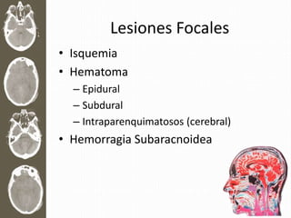 Lesiones Focales
• Isquemia
• Hematoma
– Epidural
– Subdural
– Intraparenquimatosos (cerebral)
• Hemorragia Subaracnoidea
 