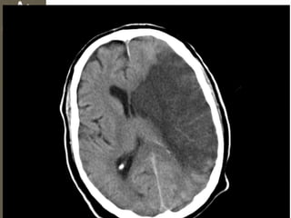 Isquemia
• Causas:
– Vasoespasmo secundario
– Aumento de la PIC
– Lesión/ Compresión Vascular
 