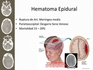 Hematoma Epidural
• Ruptura de Art. Meníngea media
• Parietooccipital: Desgarre Seno Venoso
• Mortalidad 15 – 20%
 