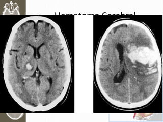 Hematoma Cerebral
• > 5ml intracerebral
• > frecuente Frontal y Temporal
• RAPIDO deterioro
• Mortalidad > 40%
 