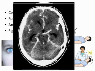 • Cefalea
• Fotofobia
• Anisocoria
• Signos Meníngeos
Brudzinski
 