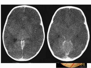 • Alt. Edo. Conciencia
• Cefalea
• Náusea/ Vomito
• Visión Borrosa
• Papiledema
• Bradicardia
 