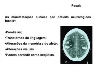 Focais


As manifestações clínicas são déficits neurológicos
focais*:


•Paralisias;
•Transtornos da linguagem;
•Alterações da memória e do afeto;
•Alterações visuais.
*Podem persistir como seqüelas.
 