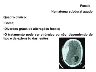 Focais
                               Hematoma subdural agudo
Quadro clínico:
•Coma;
•Diversos graus de alterações focais;
•O tratamento pode ser cirúrgico ou não, dependendo do
tipo e da extensão das lesões.
 