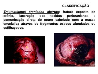 CLASSIFICAÇÃO
Traumatismos cranianos abertos: fratura exposta do
crânio,   laceração   dos   tecidos  pericranianos e
comunicação direta do couro cabeludo com a massa
encefálica através de fragmentos ósseos afundados ou
estilhaçados.
 