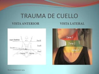 Trauma cuello 