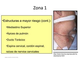 www.reeme.arizona.edu
Zona 1
•Estructuras a mayor riesgo (cont.):
•Mediastino Superior
•Ápices de pulmón
•Ducto Torácico
•Espina cervical, cordón espinal,
raíces de nervios cervicales
http://www.trauma.org/vascular/ne
ckzoneone.html
 