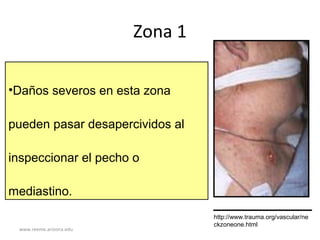 www.reeme.arizona.edu
Zona 1
•Daños severos en esta zona
pueden pasar desapercividos al
inspeccionar el pecho o
mediastino.
http://www.trauma.org/vascular/ne
ckzoneone.html
 