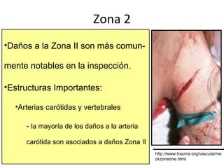 www.reeme.arizona.edu
Zona 2
•Daños a la Zona II son más comun-
mente notables en la inspección.
•Estructuras Importantes:
•Arterias carótidas y vertebrales
- la mayoría de los daños a la arteria
carótida son asociados a daños Zona II
http://www.trauma.org/vascular/ne
ckzoneone.html
 