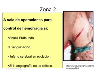 www.reeme.arizona.edu
Zona 2
A sala de operaciones para
control de hemorragia si:
•Shock Profoundo
•Exanguinación
• Infarto cerebral en evolución
•Si la angiografía no es exitosa http://www.trauma.org/vascular/ne
ckzoneone.html
 
