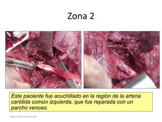 www.reeme.arizona.edu
Zona 2
Este paciente fue acuchillado en la región de la arteria
carótida común izquierda, que fue reparada con un
parcho venoso.
 