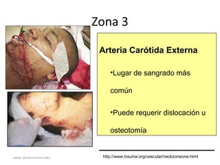 www.reeme.arizona.edu
Zona 3
Arteria Carótida Externa
•Lugar de sangrado más
común
•Puede requerir dislocación u
osteotomía
http://www.trauma.org/vascular/neckzoneone.html
 