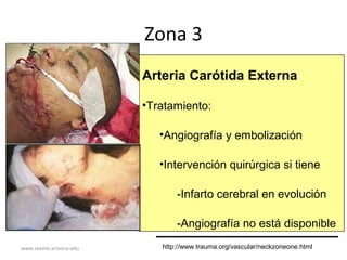 www.reeme.arizona.edu
Zona 3
Arteria Carótida Externa
•Tratamiento:
•Angiografía y embolización
•Intervención quirúrgica si tiene
-Infarto cerebral en evolución
-Angiografía no está disponible
http://www.trauma.org/vascular/neckzoneone.html
 