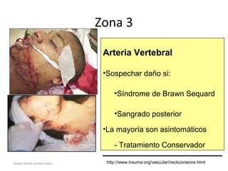 www.reeme.arizona.edu
Zona 3
Arteria Vertebral
•Sospechar daño si:
•Síndrome de Brawn Sequard
•Sangrado posterior
•La mayoría son asintomáticos
- Tratamiento Conservador
http://www.trauma.org/vascular/neckzoneone.html
 