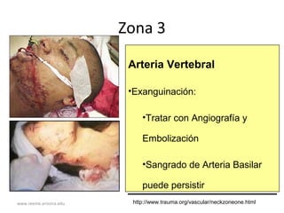 www.reeme.arizona.edu
Zona 3
Arteria Vertebral
•Exanguinación:
•Tratar con Angiografía y
Embolización
•Sangrado de Arteria Basilar
puede persistir
http://www.trauma.org/vascular/neckzoneone.html
 