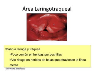 www.reeme.arizona.edu
Área Laringotraqueal
•Daño a laringe y tráquea
•Poco común en heridas por cuchillas
•Alto riesgo en heridas de balas que atraviesan la línea
media
www.reeme.arizona.edu
 