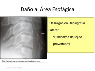 www.reeme.arizona.edu
Daño al Área Esofágica
•Hallazgos en Radiografía
Lateral:
•Hinchazón de tejido
prevertebral
http://www.trauma.org/vascular/neckoeso.html
 