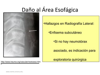 www.reeme.arizona.edu
Daño al Área Esofágica
•Hallazgos en Radiografía Lateral:
•Enfisema subcutáneo
•Si no hay neumotórax
asociado, es indicación para
exploratoria quirúrgica
http://www.trauma.org/vascular/neckoeso.htm
l
 