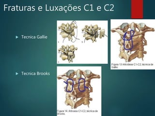 Fraturas e Luxações C1 e C2
 Tecnica Gallie
 Tecnica Brooks
 
