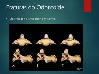 Fraturas do Odontoide
 Classificação de Anderson e D’Alonso
 