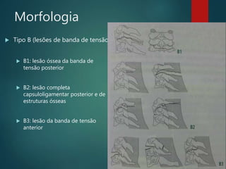 Morfologia
 Tipo B (lesões de banda de tensão)
 B1: lesão óssea da banda de
tensão posterior
 B2: lesão completa
capsuloligamentar posterior e de
estruturas ósseas
 B3: lesão da banda de tensão
anterior
 
