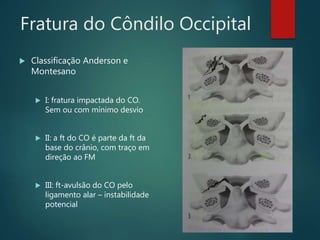 Fratura do Côndilo Occipital
 Classificação Anderson e
Montesano
 I: fratura impactada do CO.
Sem ou com mínimo desvio
 II: a ft do CO é parte da ft da
base do crânio, com traço em
direção ao FM
 III: ft-avulsão do CO pelo
ligamento alar – instabilidade
potencial
 