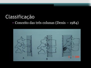 Classificação
• Conceito das três colunas (Denis – 1984)
 