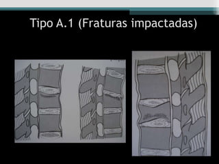 Tipo A.1 (Fraturas impactadas)
 