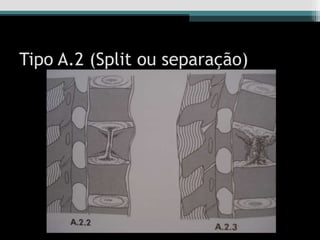 Tipo A.2 (Split ou separação)
 