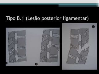 Tipo B.1 (Lesão posterior ligamentar)
 