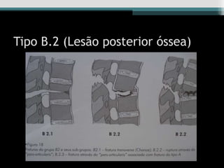 Tipo B.2 (Lesão posterior óssea)
 