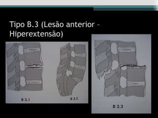 Tipo B.3 (Lesão anterior –
Hiperextensão)
 