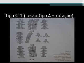 Tipo C.1 (Lesão tipo A + rotação)
 