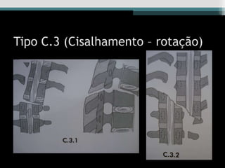 Tipo C.3 (Cisalhamento – rotação)
 