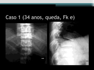 Caso 1 (34 anos, queda, Fk e)
 