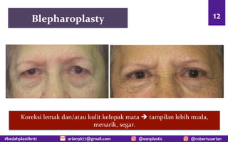 #bedahplastikntt @robertusarian
arian9677@gmail.com @eanplastic
Blepharoplasty 12
Koreksi lemak dan/atau kulit kelopak mata è tampilan lebih muda,
menarik, segar.
 