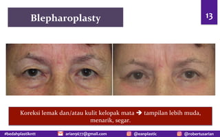 #bedahplastikntt @robertusarian
arian9677@gmail.com @eanplastic
Blepharoplasty 13
Koreksi lemak dan/atau kulit kelopak mata è tampilan lebih muda,
menarik, segar.
 
