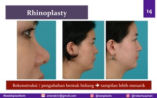 #bedahplastikntt @robertusarian
arian9677@gmail.com @eanplastic
Rhinoplasty 14
Rekonstruksi / pengubahan bentuk hidung è tampilan lebih menarik
 