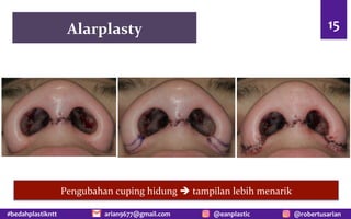 #bedahplastikntt @robertusarian
arian9677@gmail.com @eanplastic
Alarplasty 15
Pengubahan cuping hidung è tampilan lebih menarik
 