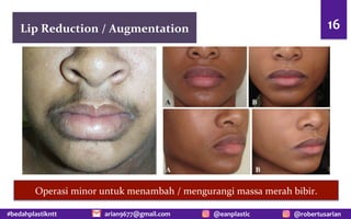 #bedahplastikntt @robertusarian
arian9677@gmail.com @eanplastic
Lip Reduction / Augmentation 16
Operasi minor untuk menambah / mengurangi massa merah bibir.
 