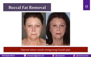 #bedahplastikntt @robertusarian
arian9677@gmail.com @eanplastic
Buccal Fat Removal 17
Operasi minor untuk mengurangi lemak pipi.
 