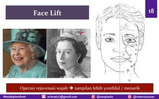#bedahplastikntt @robertusarian
arian9677@gmail.com @eanplastic
Face Lift 18
Operasi rejuvenasi wajah è tampilan lebih youthful / menarik
 
