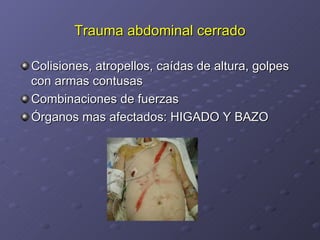 Trauma abdominal cerrado Colisiones, atropellos, caídas de altura, golpes con armas contusas Combinaciones de fuerzas Órganos mas afectados: HIGADO Y BAZO 