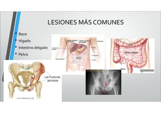 LESIONES MÁS COMUNES
• Bazo
• Hígado
• Intestino delgado
• Pelvis
 