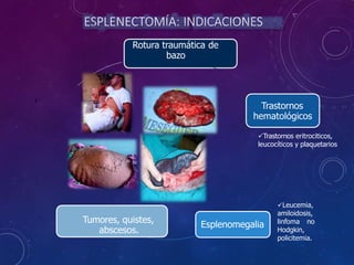 ESPLENECTOMÍA: INDICACIONES
Rotura traumática de
bazo
Trastornos
hematológicos
Esplenomegalia
Tumores, quistes,
abscesos.
l
Trastornos eritrociticos,
leucocíticos y plaquetarios
Leucemia,
amiloidosis,
linfoma no
Hodgkin,
policitemia.
 