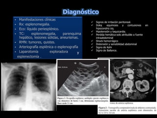  Signos de irritación peritoneal.
 Dolor
, equimosis y contusiones en
hipocondrio izq.
 Hipotensión y taquicardia.
 Perdida hemática solo atribuible a fuente
intraabdominal
 Shock hemorrágico
 Distensión y sensibilidad abdominal
 Signo de Kehr
 Signo de Ballance.
y
 